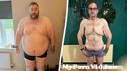 Man who lost 24 stone faces paying £40k to go private for excess skin removal from ebony big op Watch Video - MyPornVid.fun