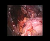 SAGES - Minimally Invasive Surgery Videos
