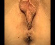 Reducing long labia minora and clitoral hood excess for cosmetic and functional improvements.
