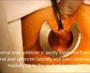This edited video shows the author&#39;s approach and method for performing lateral anal sphincterotomy for chronic anal fissure under perianal anaesthesia. This video is associated with a text under submission for publication in the journal Colorectal Disease.nnNarimantas E.Samalavicius(1,2), Edgaras Smolskas(3), Vita Klimasauskiene(1), Stasys Mikuzis(1), Audrius Dulskas(2,4,5).nn(1) Department of Surgery, Klaipeda University Hospital, 41 Liepojos Str., LT-92288 Klaipeda, Lithuanian(2) Institute of