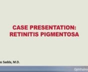 Dr. SriniVas Sadda shares a case study of a patient with Retinitis Pigmentosa.