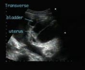 Note massively dilated fluid-filled septate vagina compressing the bladder towards the left. One uterine cavity is outlined by fluid and a second cervical os is suspected in some views. The labia are separated by the bulging imperforate hymen. Mild hydronephrosis is also noted.; Note massively dilated fluid-filled septate vagina compressing the bladder towards the left. One uterine cavity is outlined by fluid and a second cervical os is suspected in some views. The labia are separated by the bul