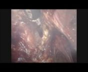 This is the case of a 45 year old woman undergoing total laparoscopic hysterectomy and bilateral salpingo-ophorectomy for heavy and painful menstrual bleeding. She has previously had a uterine artery embolisation for fibroids. On laparoscopy the uterus was 12 week size and the rectum was adherent to the posterior side of the cervix due to endometriosis obliterating the pouch of Douglas. nSurgical approach should be systematic aiming to restore the normal anatomy of the pelvis before proceeding w
