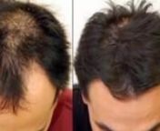Propecia finasteride 1mg - before and after photos from 1mg