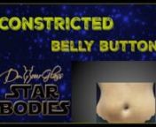 Hi, this is Dr. Hourglass, and welcome to another video in our channel Star Bodies. Today we are going to discuss the constricted belly button. In this channel, we discuss everything you need to know to get that star body that you want.nnThe tummy tuck is one of the most common aesthetic procedures to enhance the abdomen. With this technique, the excess skin below the belly button is removed, the muscle of the abdomen are tightened, the excess fat is removed, and it will result in a lower scar t