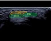 Ultrasound of the distal intersection in the wrist as EPL crosses the ECR tendons.