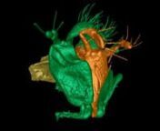 This video shows a rotating 3D reconstruction of the chewing mouthparts of the Zasphinctus sarowiwai ant, one of the three new species the OIST researchers described in their research. This is the first time that mouthparts are visualized in 3D in their original configuration. The yellow section shows the labrum, or the ant’s upper lip, the green section shows the maxillae, or the lower jaw, and the orange section shows the labium, or the lower lip. The various antennae-like appendages are cal