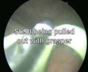 This video shows the steps in removing a ureteral stent with a cystoscope. The patient is a male with a left ureteral stent in place.