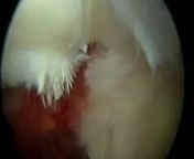 http://www.shoulder-arthroscopy.co.uk/nnBiceps Tendonosis - Left ShouldernnNew and improved video with voice-overs from Consultant Orthopedic surgeons Mr. Simon Moyes and Mr. Omar Haddo