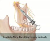 Created as an academic project while at the Medical College of Georgia as a medical illustrator in training, this video outlines the procedure for giving a Gow-Gate&#39;s nerve block. This nerve block is used to anesthetize most of the inferior unilateral jaw.Media: pencil, photoshop, aftereffects