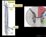 Screencast of mini lecture on anatomy of spinal cord injury covering the infamous brown-seqard syndrome and a recent case report PMID 22124685