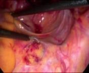 Posted 15/12/11. This video illustrates dissection of the presacral space and mesh attachment to the vagina using intracorporeal knot tying techniques, and mesh coverage with peritoneum