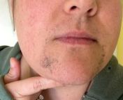 A woman who grew facial hair aged 13 and spent &#36;10k on laser hair removal has now accepted her beard and says it doesn&#39;t &#92;