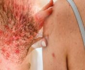 Seborrheic dermatitis: कई बार आपने गौर किया होगा कि आप नहाकर आते हैं और शरीर पर दाने निकल आते हैं। पर ज्यादातर लोग इसके कारणों के बारे में नहीं जानते हैं। आइए, विस्तार से समझते हैं। &#60;br/&#62; &#60;br/&#62;Seborrheic dermatitis: Many times you might have noticed that after taking a bath, rashes appear on your body. But most people do not know about its reasons. Let us understand in detail. &#60;br/&#62; &#60;br/&#62;#Seborrheicdermatitis#Skin &#60;br/&#62;~HT.97~PR.115~ED.284~