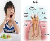 दांत हमारे शरीर का एक महत्वपूर्ण हिस्सा है। यह न सिर्फ खाना चबाने में हमारी मदद करते हैं, बल्कि बोलने में भी अहम भूमिका निभाते हैं। किसी भी व्यक्ति के जीवन में उसके 2 बार दांत निकलते हैं, जिसमें एक दूध के दांत कहलाते हैं। शिशु अवस्था में जो दांत निकलने शुरू होते हैं उन्हें दूध के दांत कहा जाता है, जो अक्सर 6 से 7 साल की उम्र में टूट जाते हैं. पर कई बार हम डाँडो की ठीक से देखभाल नहीं करते जिसका खामियाजा हमे बाद में उठाना पड़ता है,&#60;br/&#62; &#60;br/&#62;Teeth are an important part of our body. They not only help us in chewing food, but also play an important role in speaking. In any person&#39;s life, teeth emerge twice, one of which is called milk teeth. The teeth that start emerging in infancy are called milk teeth, which often fall out at the age of 6 to 7 years. But many times we do not take proper care of the sticks, due to which we have to bear the consequences later. &#60;br/&#62; &#60;br/&#62;#DeciduosTeethInfection, #ToothInfectionSymptomsInKids, #ToothInfectionTreatmentInKids&#60;br/&#62;~PR.266~ED.284~